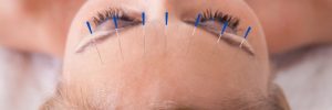 Why You Should Ditch Your Dermatologist Acupuncture e1465495238265