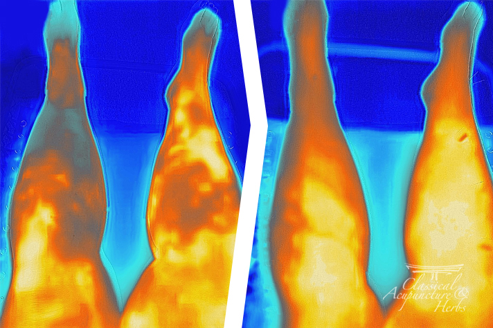 Thermography images showing the before and after effects of acupuncture on a woman's legs