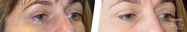 Thermography images showing the before and after effects of cosmetic acupuncture and facial rejuvenation around a woman's eye