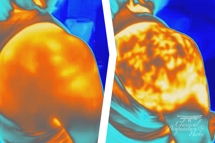 Thermography images showing the before and after effects of cupping therapy on a man's shoulder