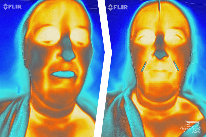 Thermography images showing the before and after effects of sinus issues on a woman's face