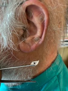 Ear seeds taped onto the ear of an elderly man, used in auriculotherapy, a form of alternative medicine